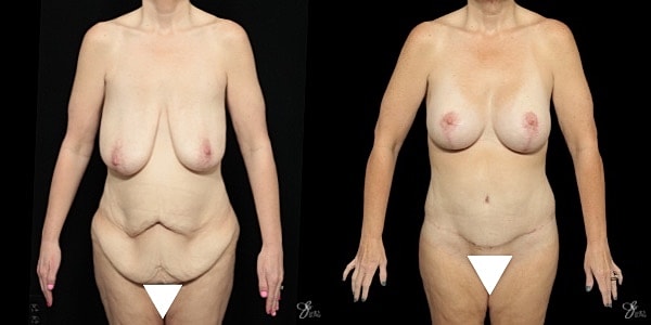 Mommy Makeover Before & After