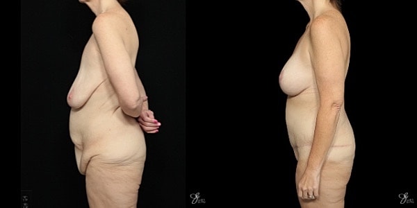 Mommy Makeover Before & After