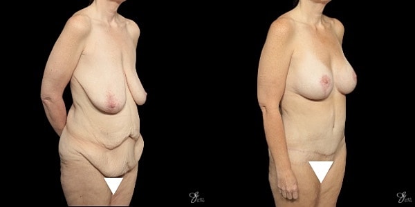 Mommy Makeover Before & After