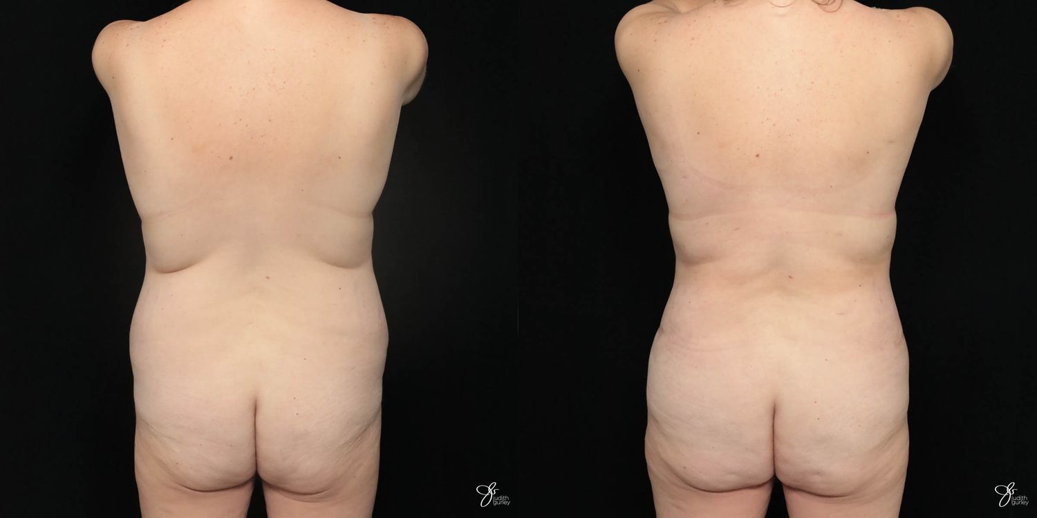 Mommy Makeover Before & After