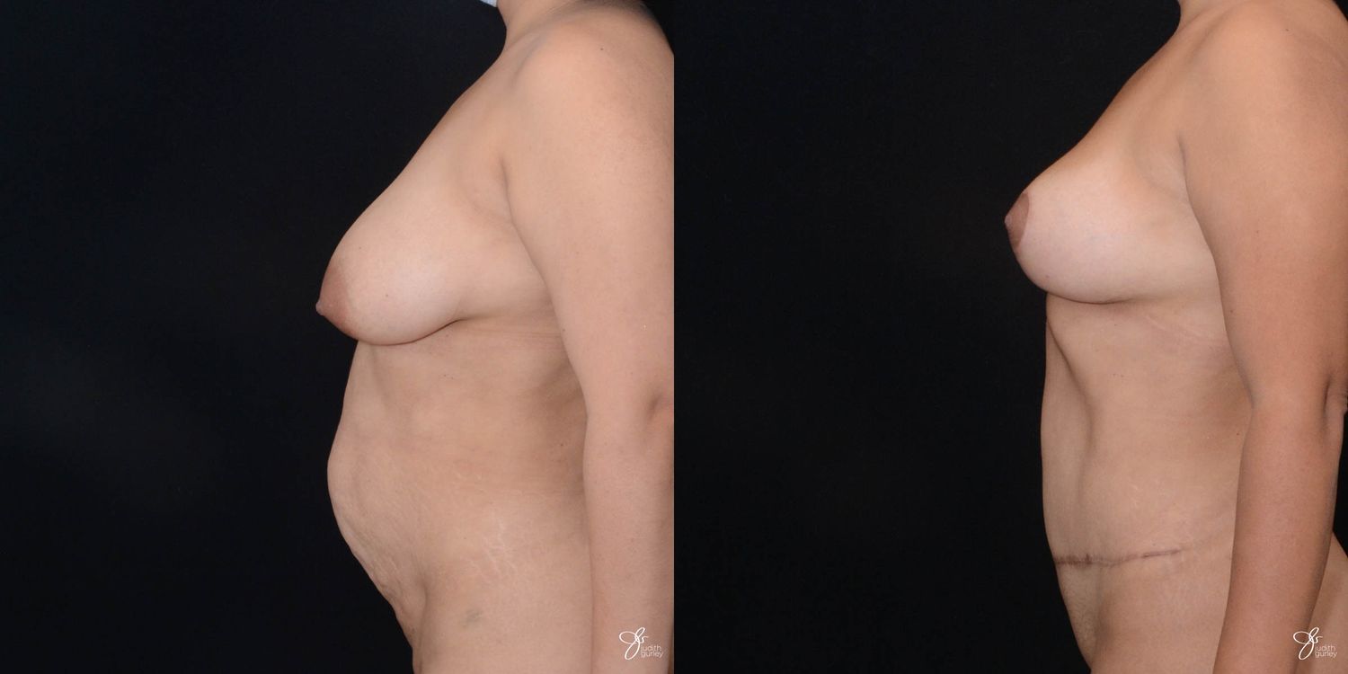 Mommy Makeover Before & After