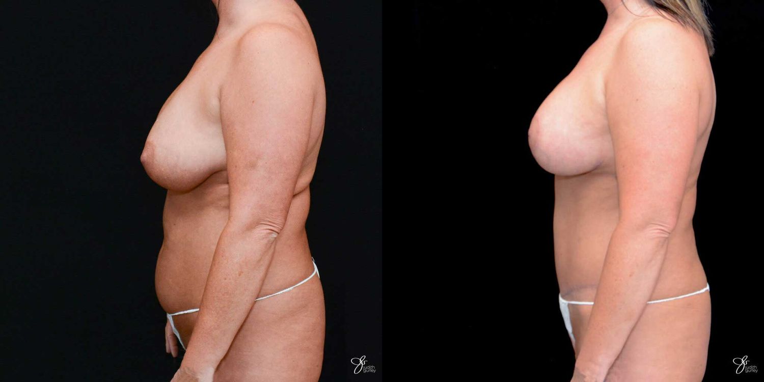 Mommy Makeover Before & After