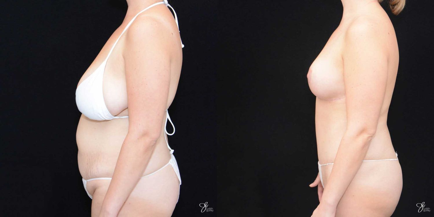 Mommy Makeover Before & After