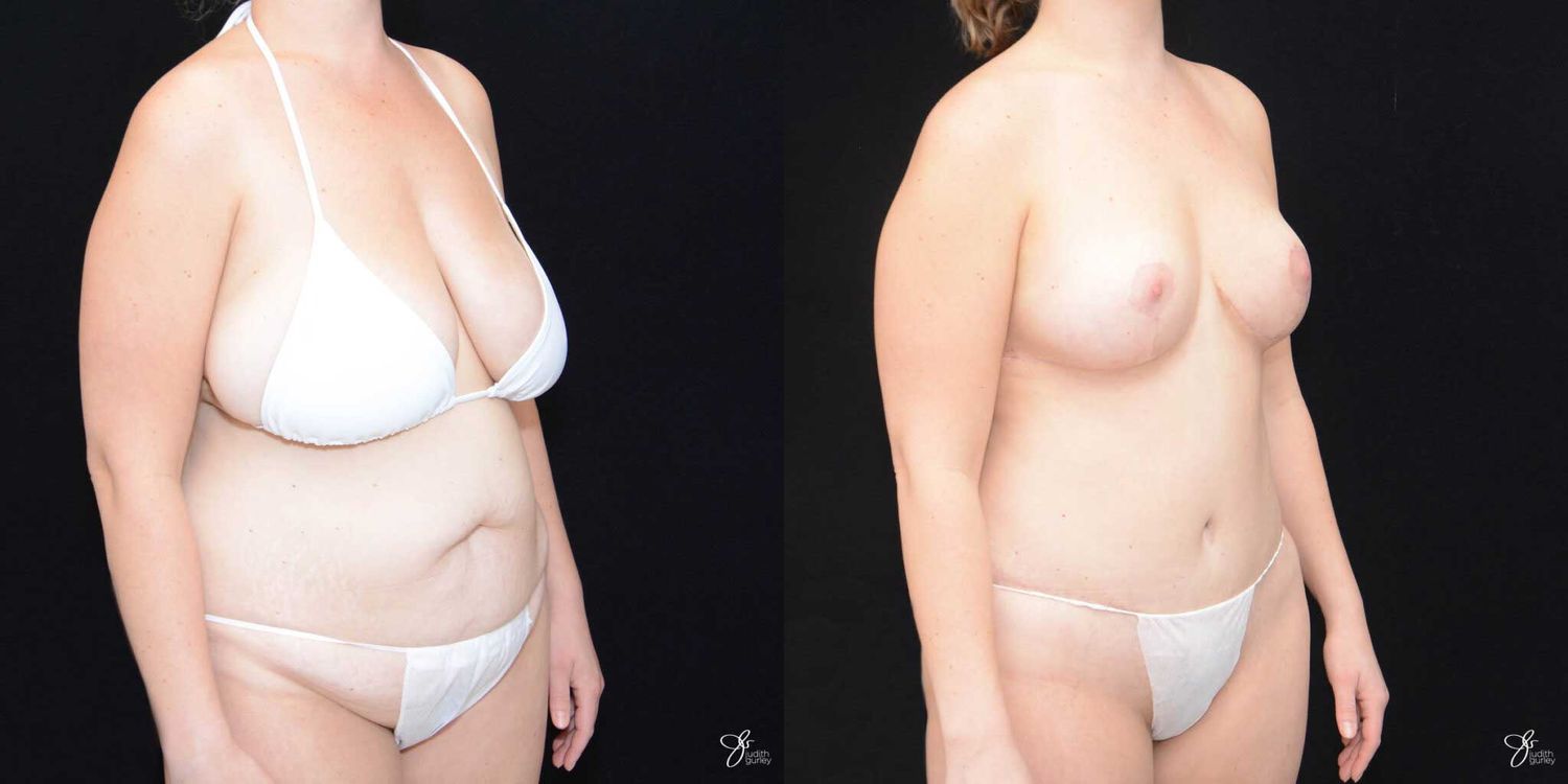 Mommy Makeover Before & After