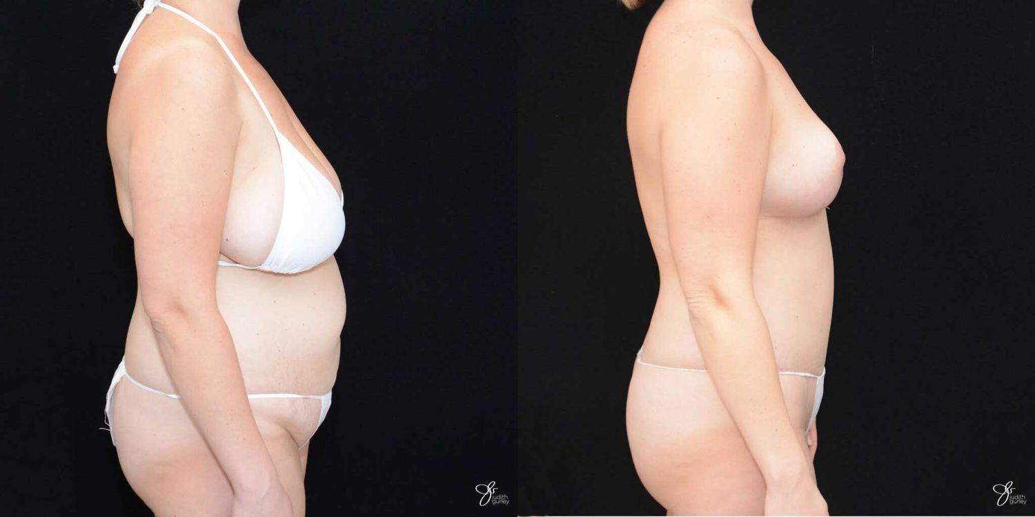 Mommy Makeover Before & After