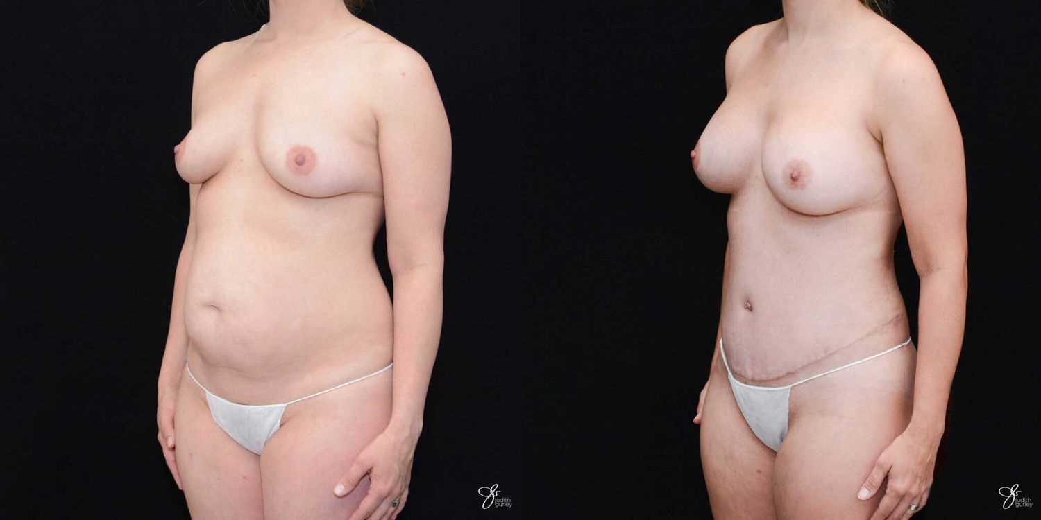 Mommy Makeover Before & After