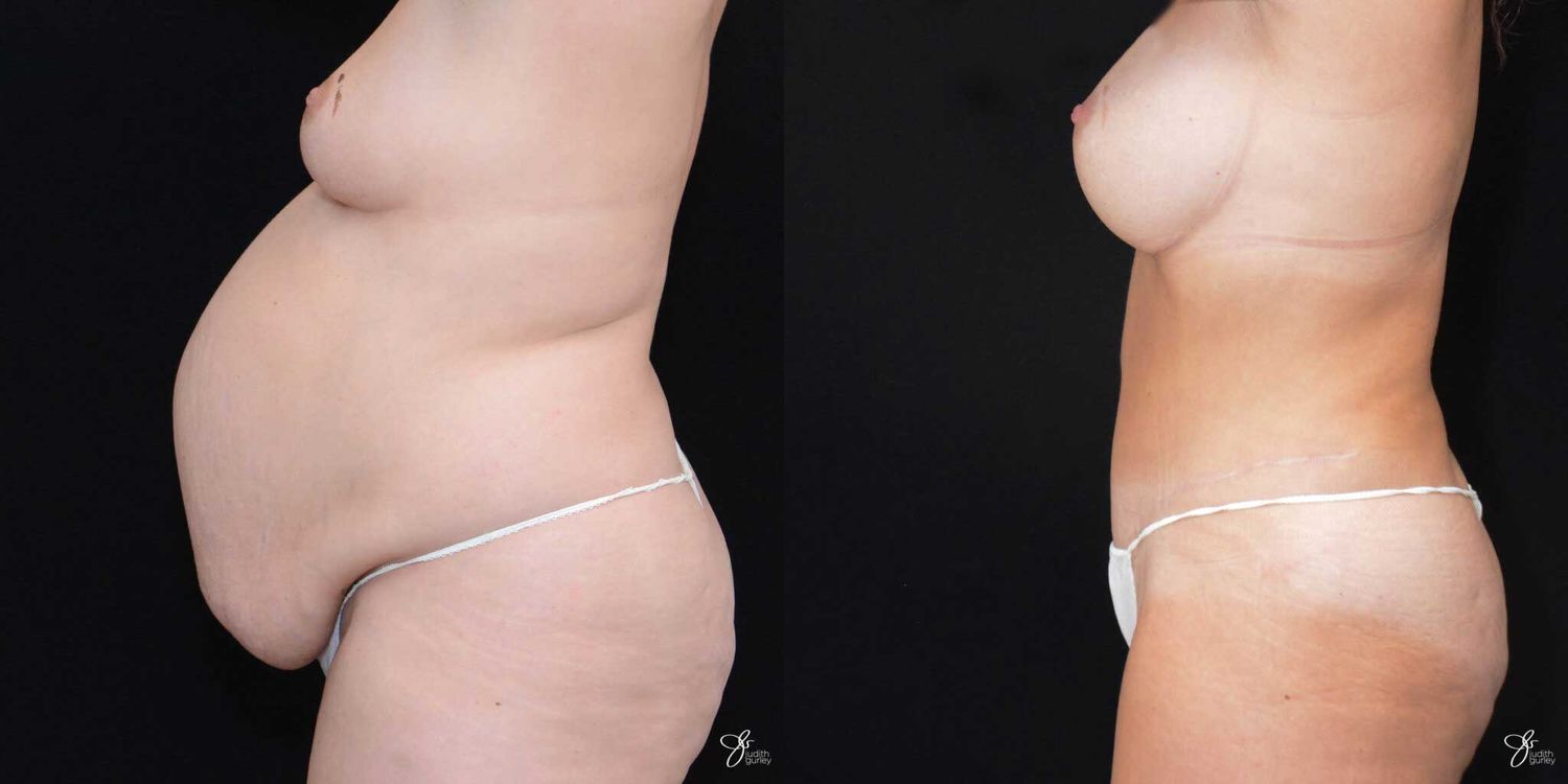 Mommy Makeover Before & After