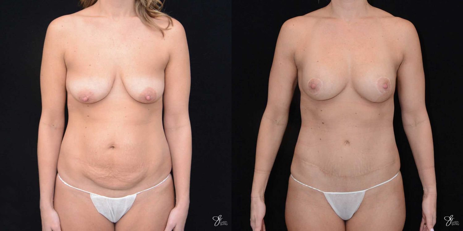 Mommy Makeover Before & After