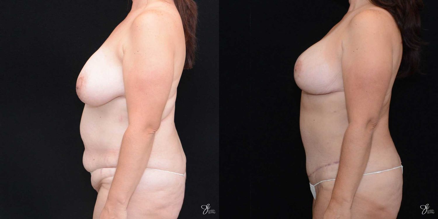 Mommy Makeover Before & After