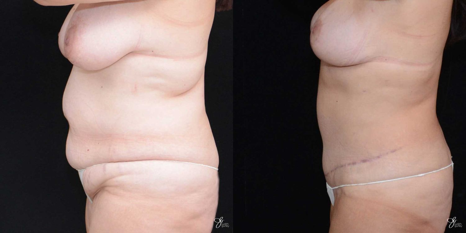 Mommy Makeover Before & After