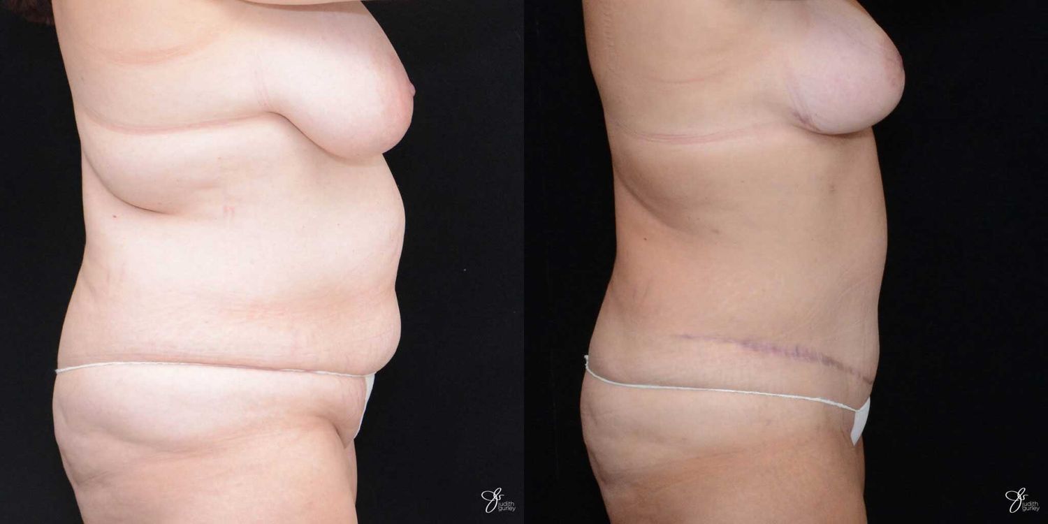 Mommy Makeover Before & After