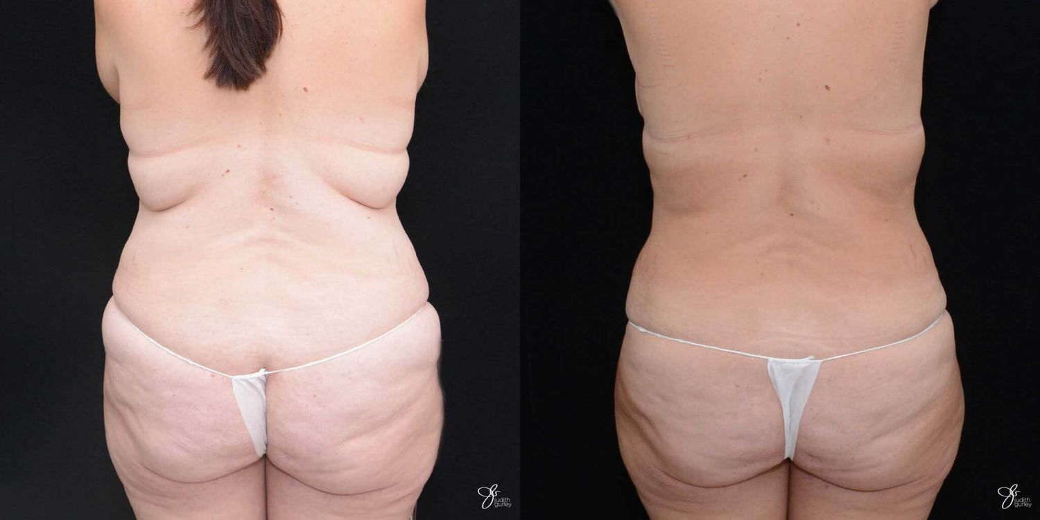 Mommy Makeover Before & After