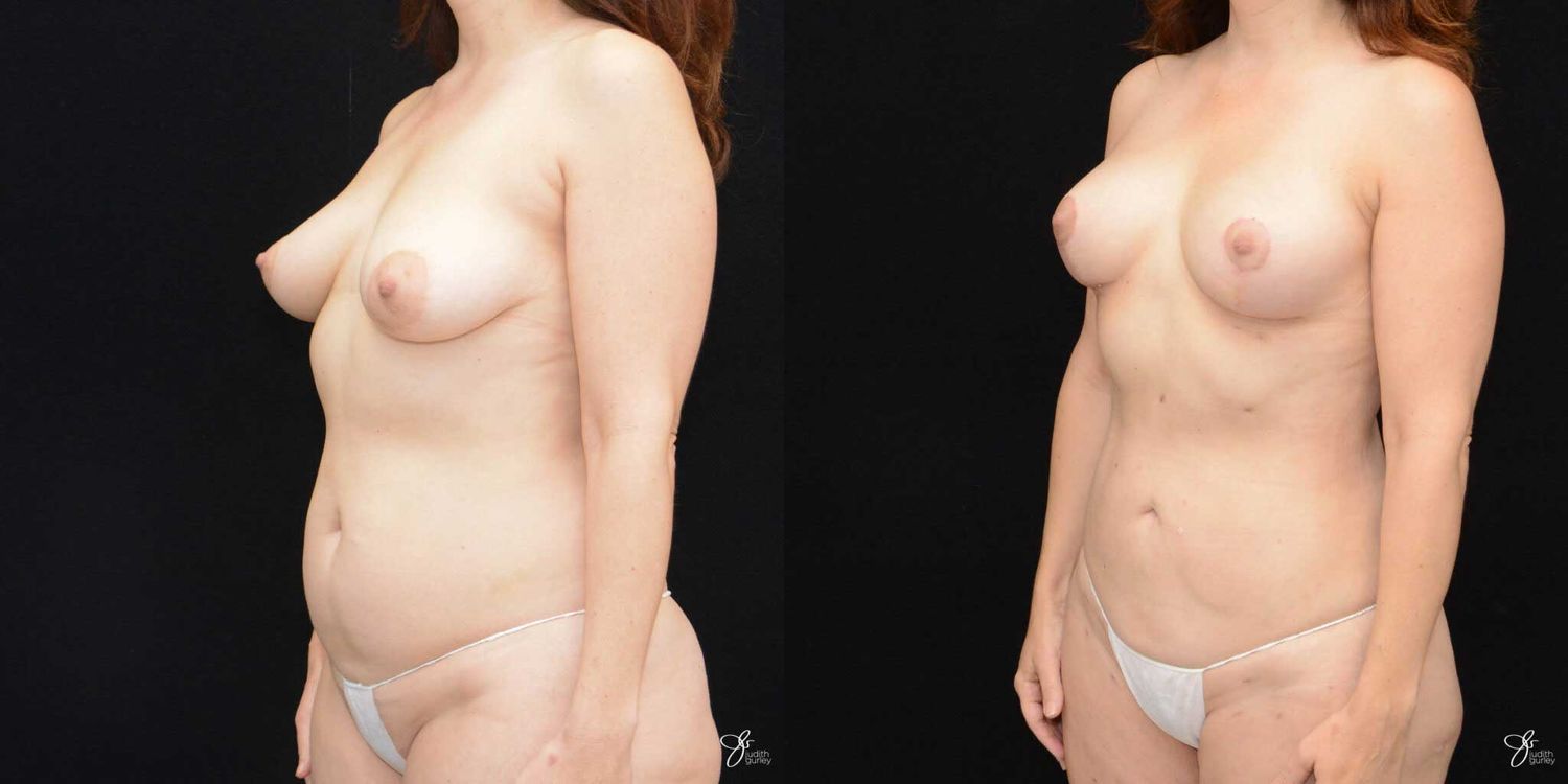 Mommy Makeover Before & After