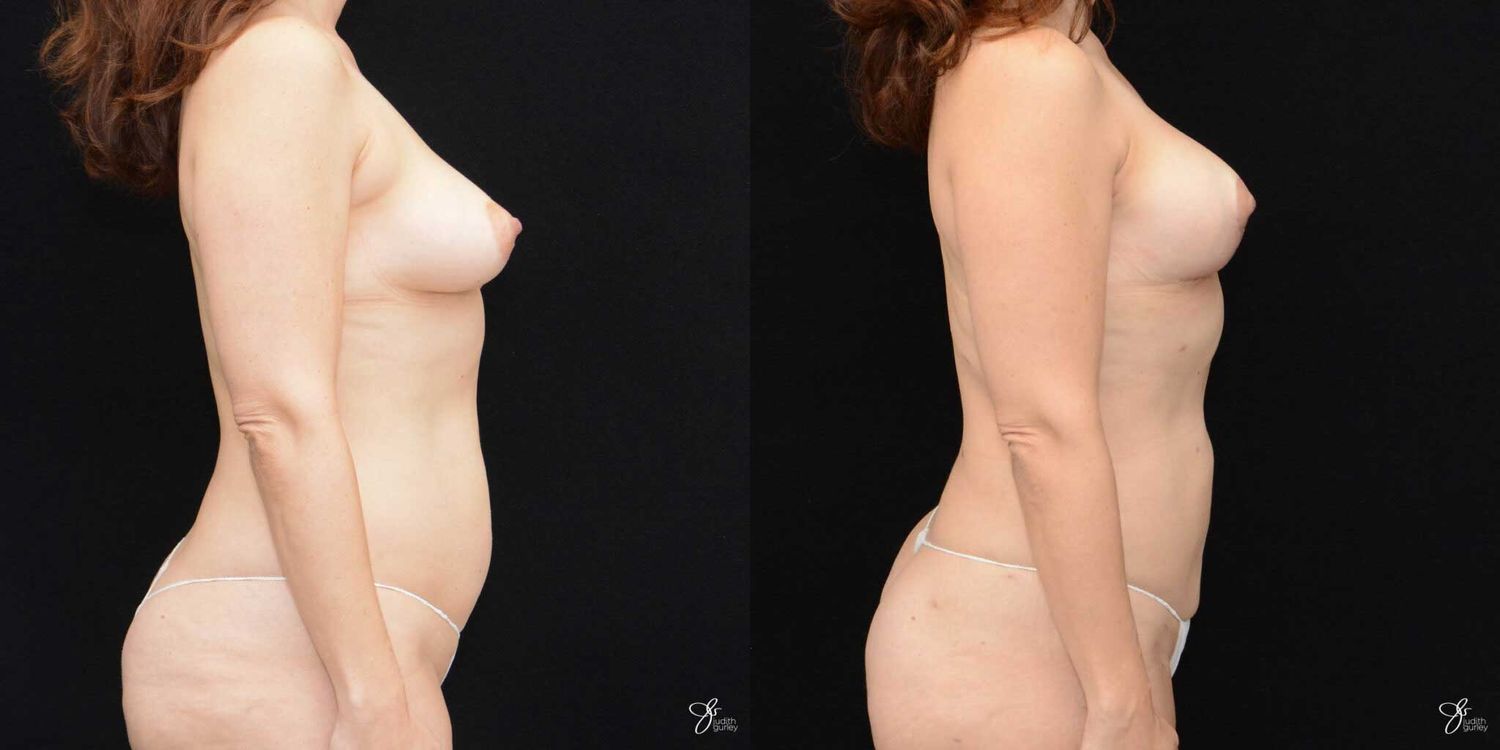 Mommy Makeover Before & After