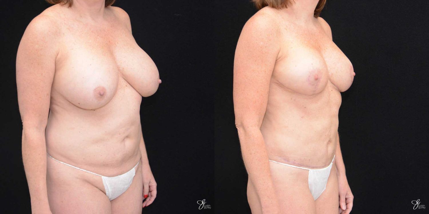 Mommy Makeover Before & After