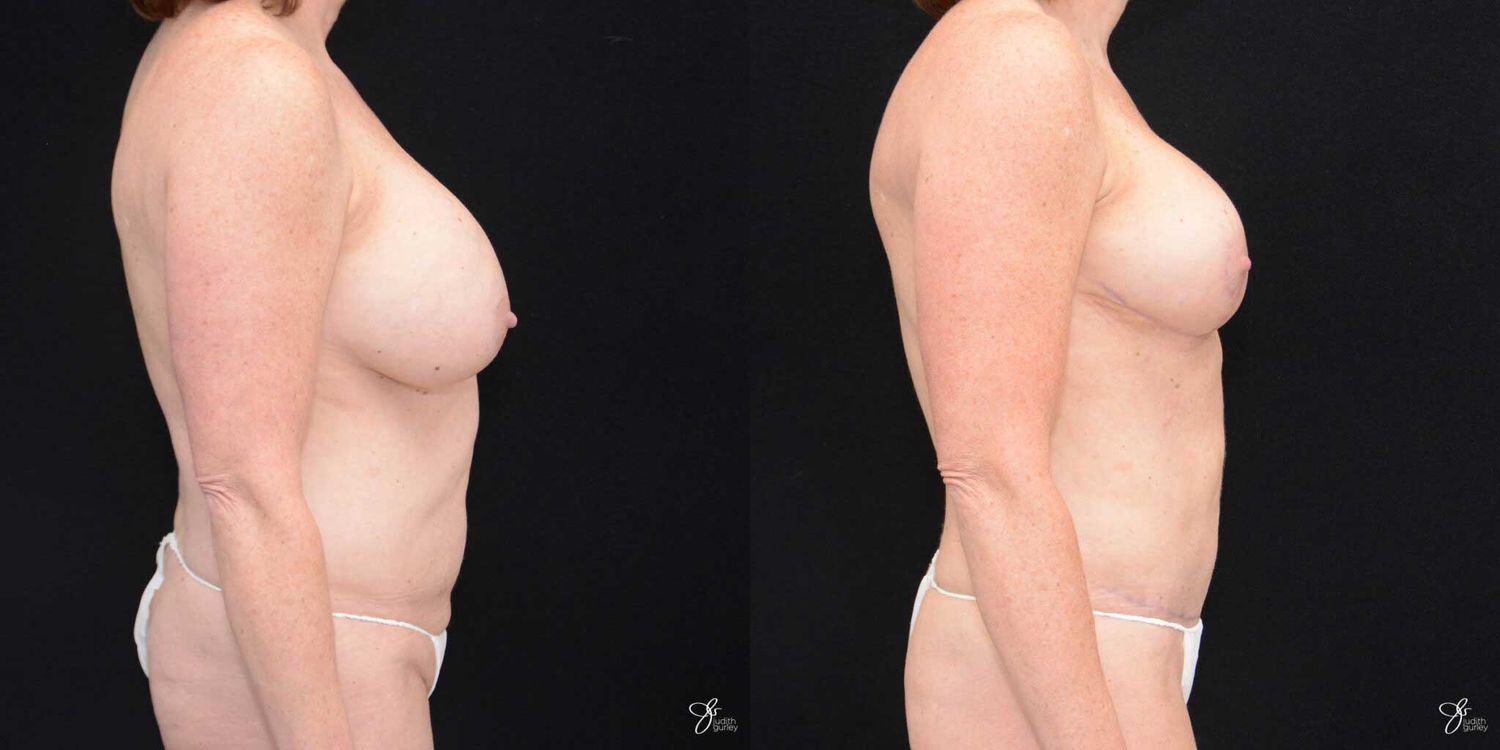 Mommy Makeover Before & After