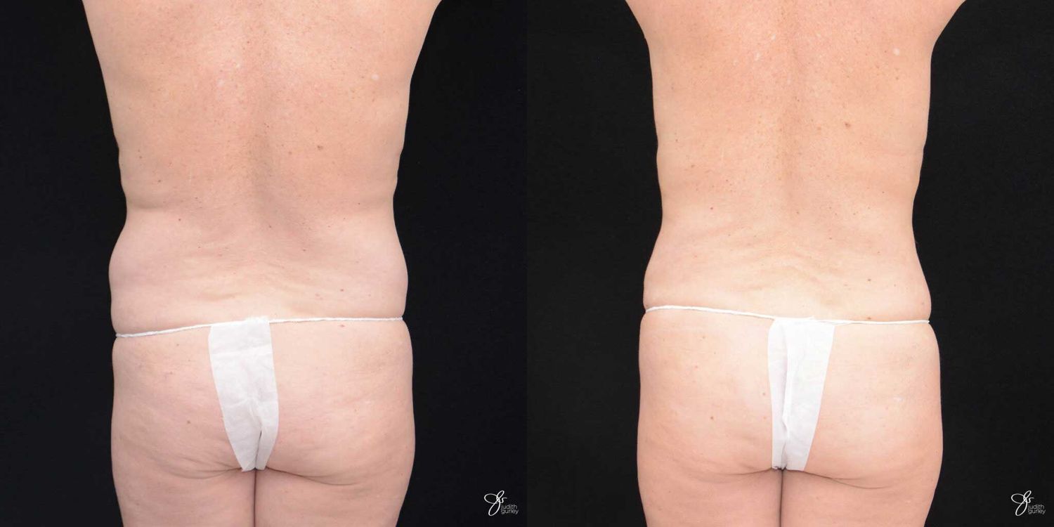 Mommy Makeover Before & After