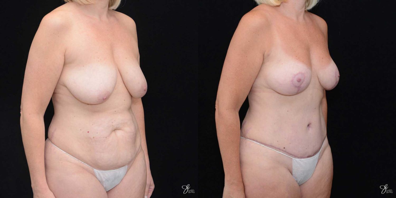 Mommy Makeover Before & After