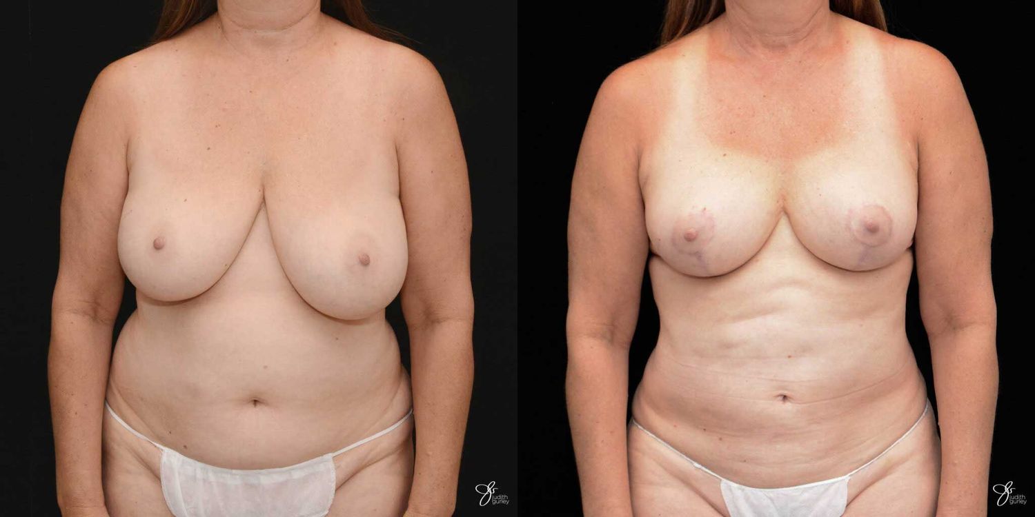 Mommy Makeover Before & After