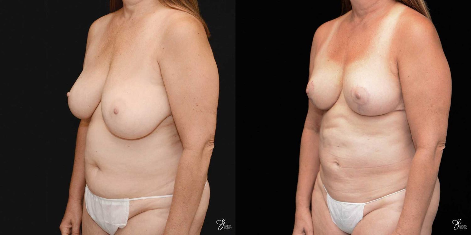 Mommy Makeover Before & After