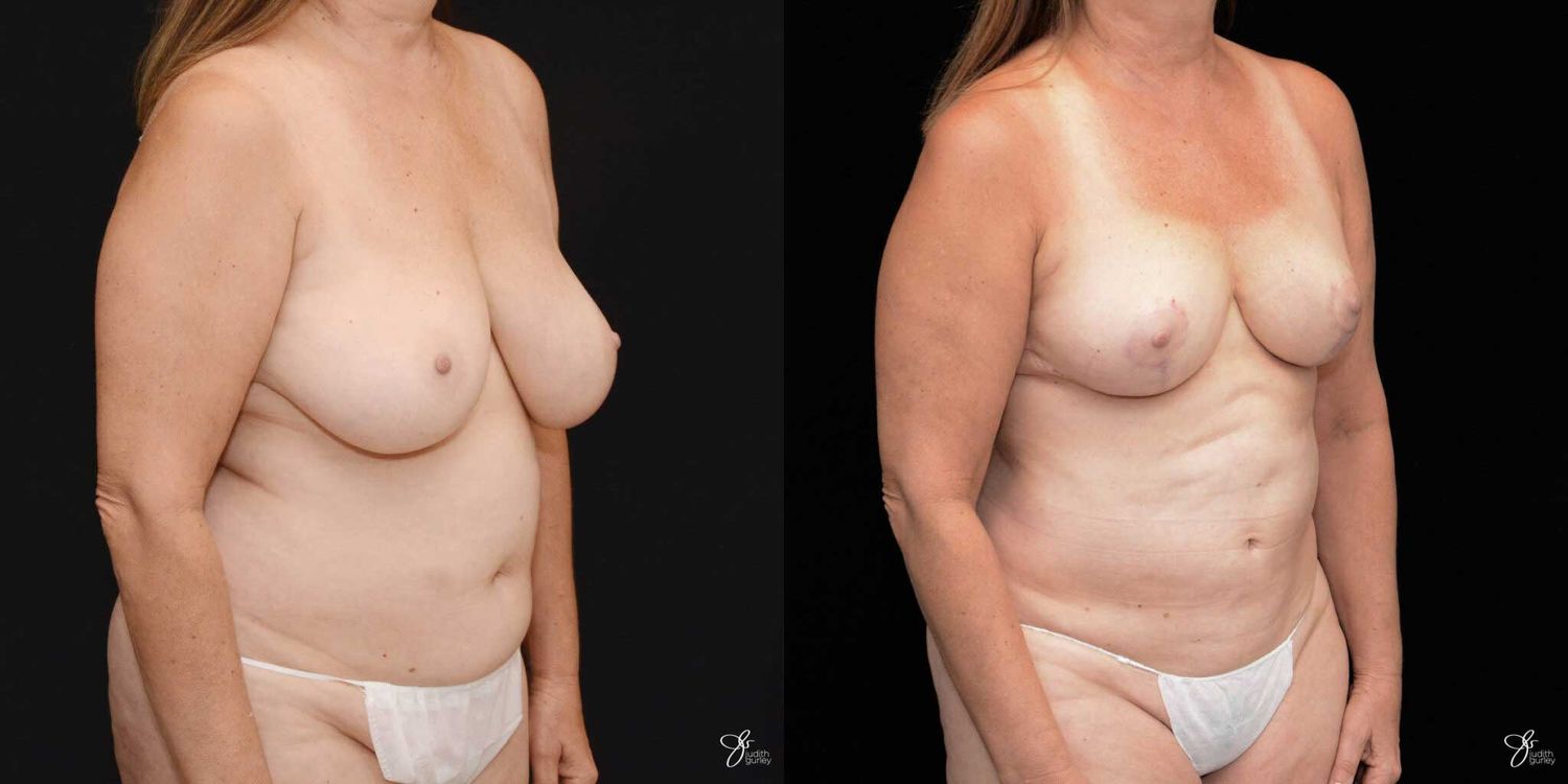 Mommy Makeover Before & After