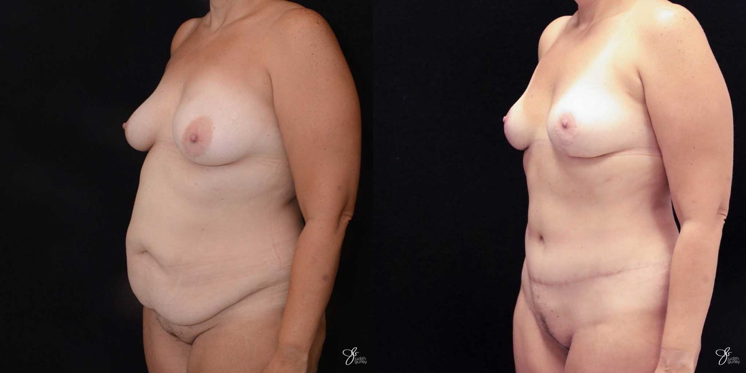 Mommy Makeover Before & After