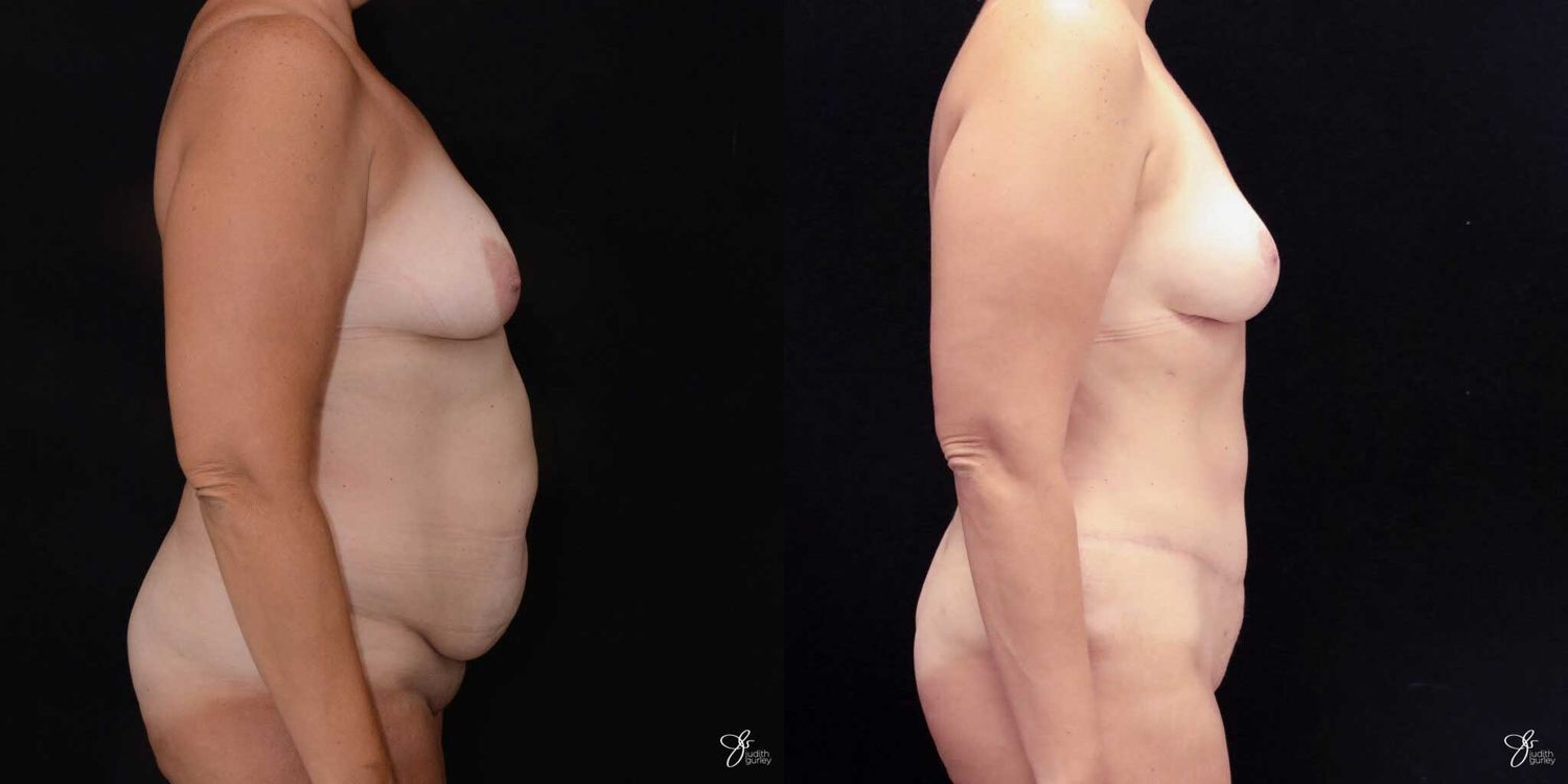 Mommy Makeover Before & After