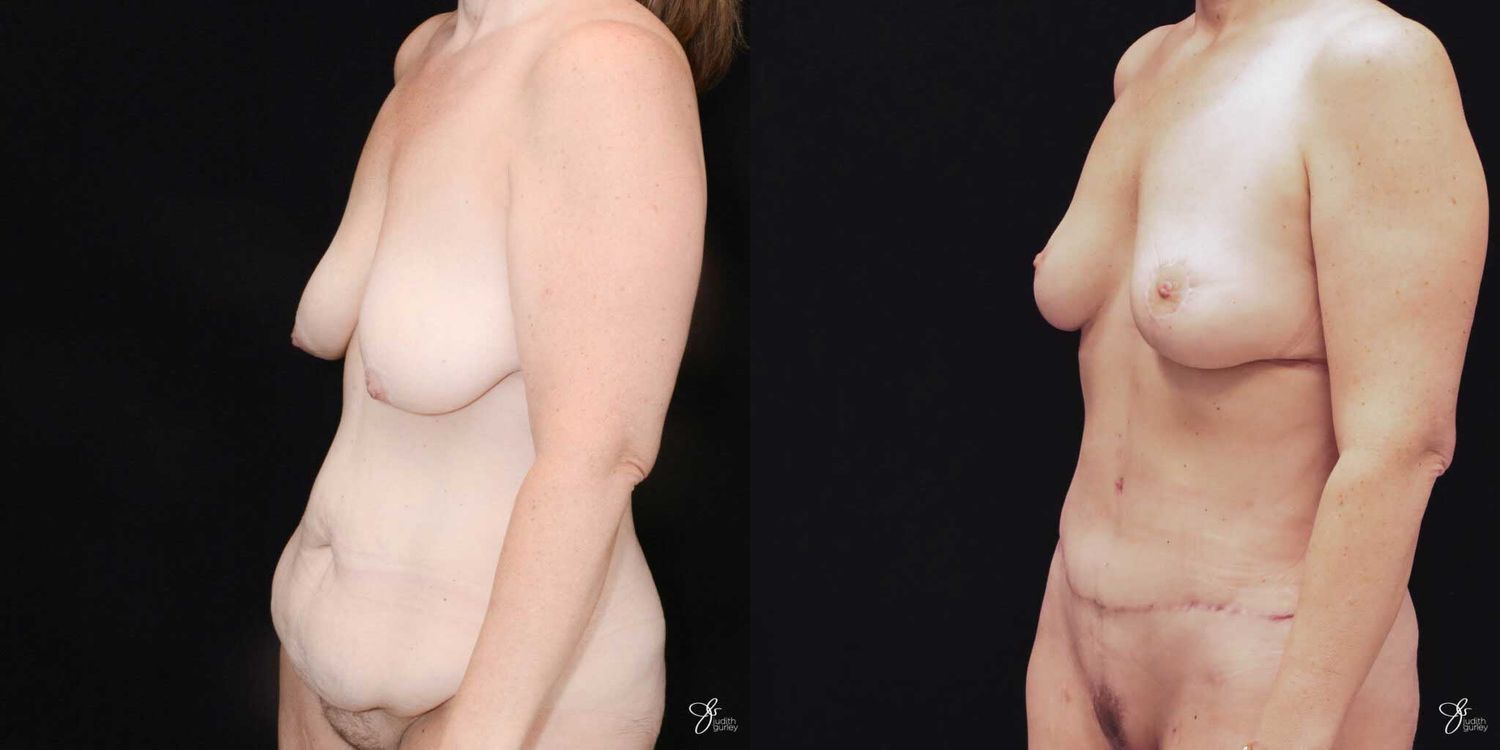 Mommy Makeover Before & After