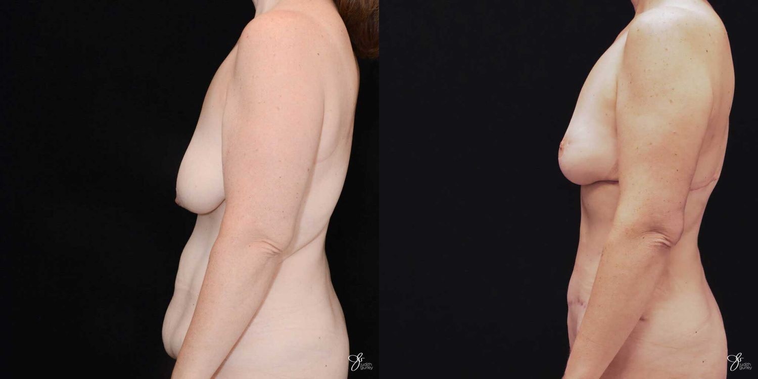 Mommy Makeover Before & After