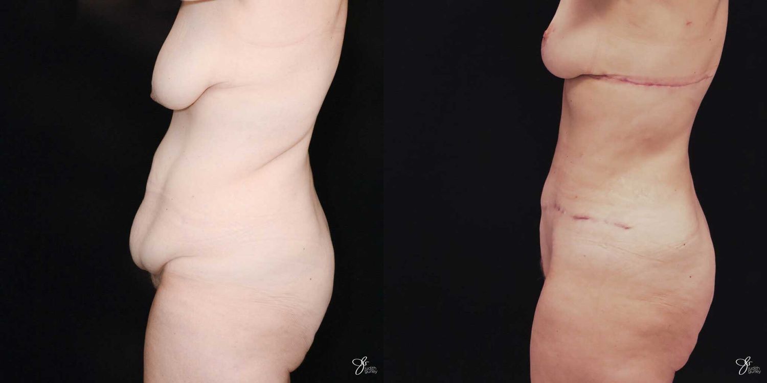 Mommy Makeover Before & After