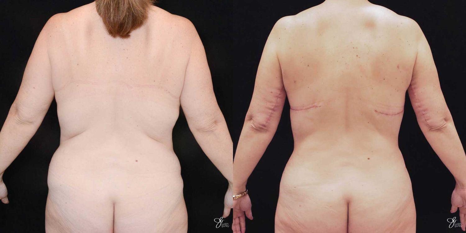 Mommy Makeover Before & After