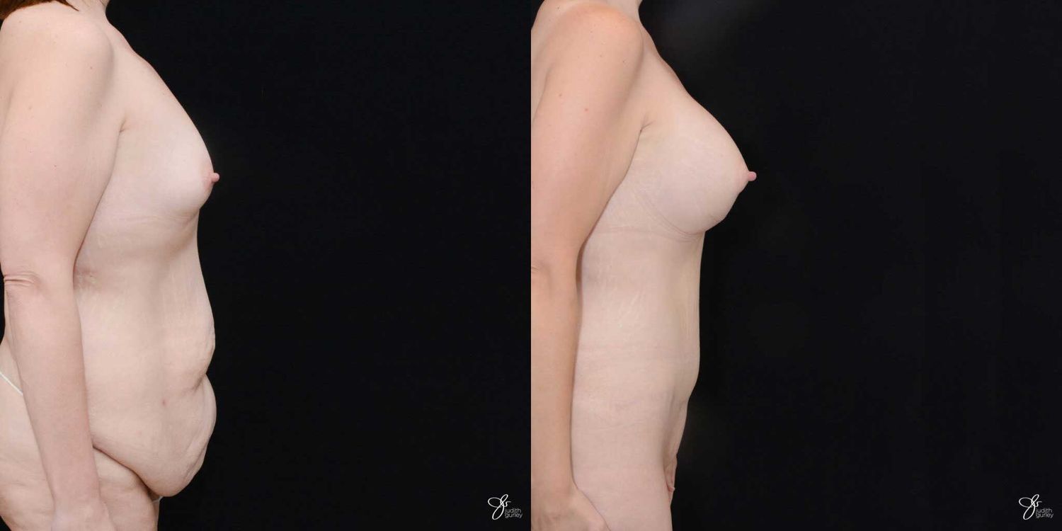 Mommy Makeover Before & After