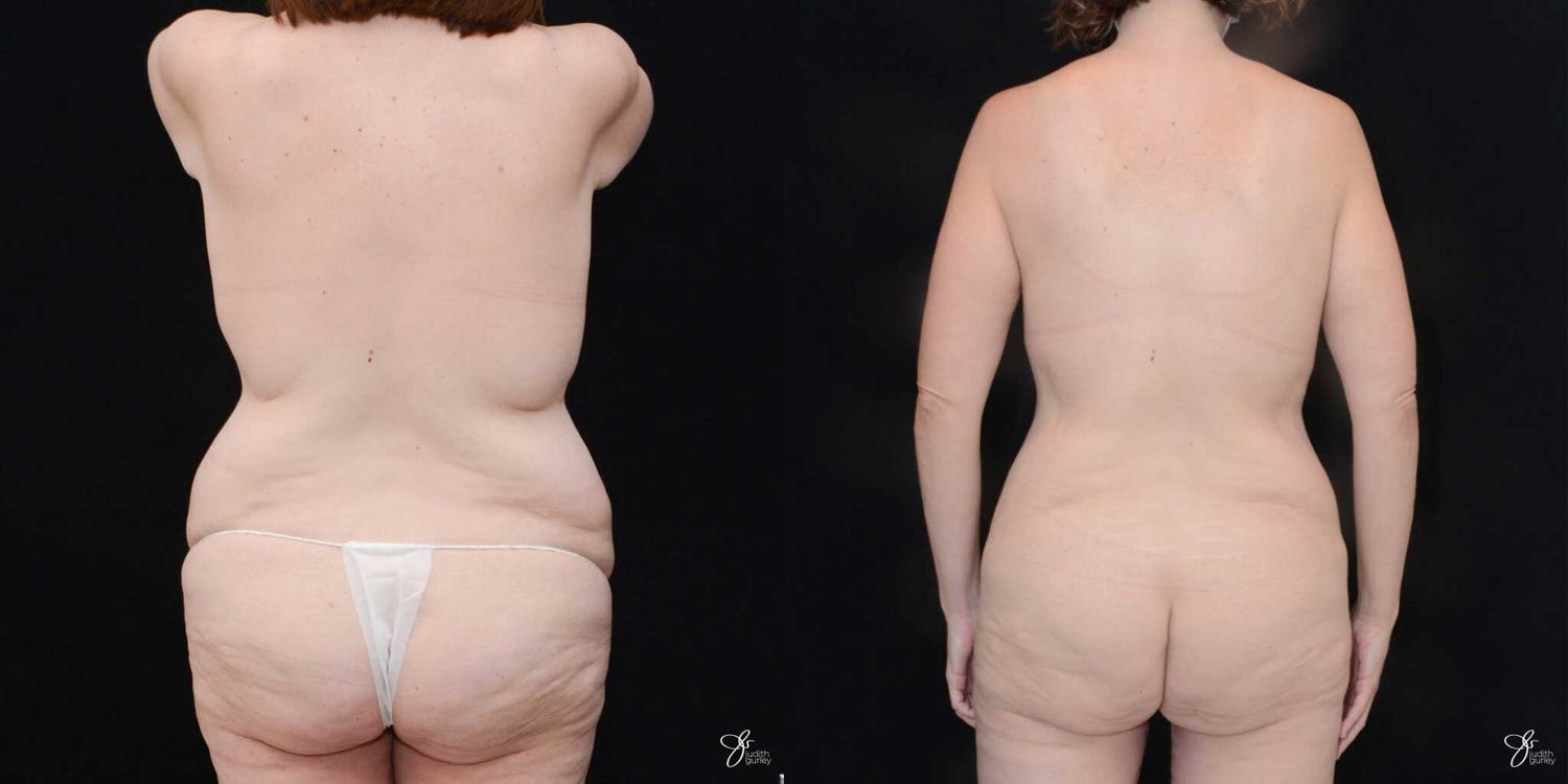 Mommy Makeover Before & After