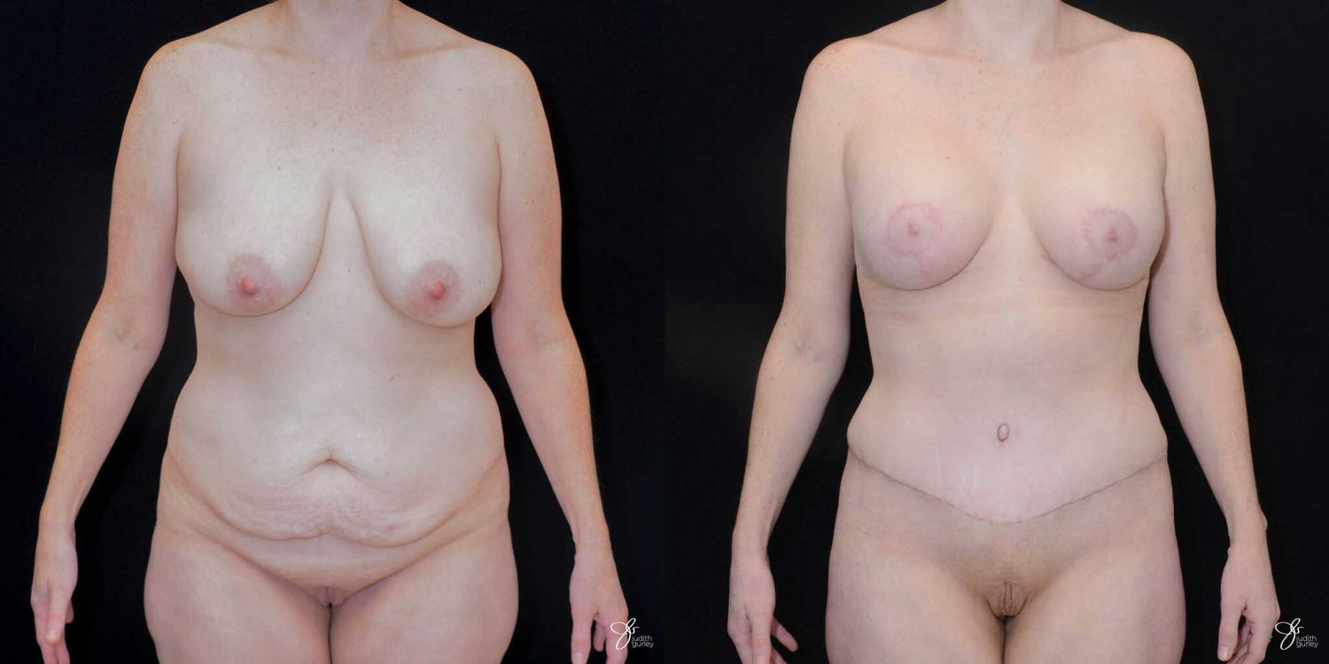 Mommy Makeover Before & After