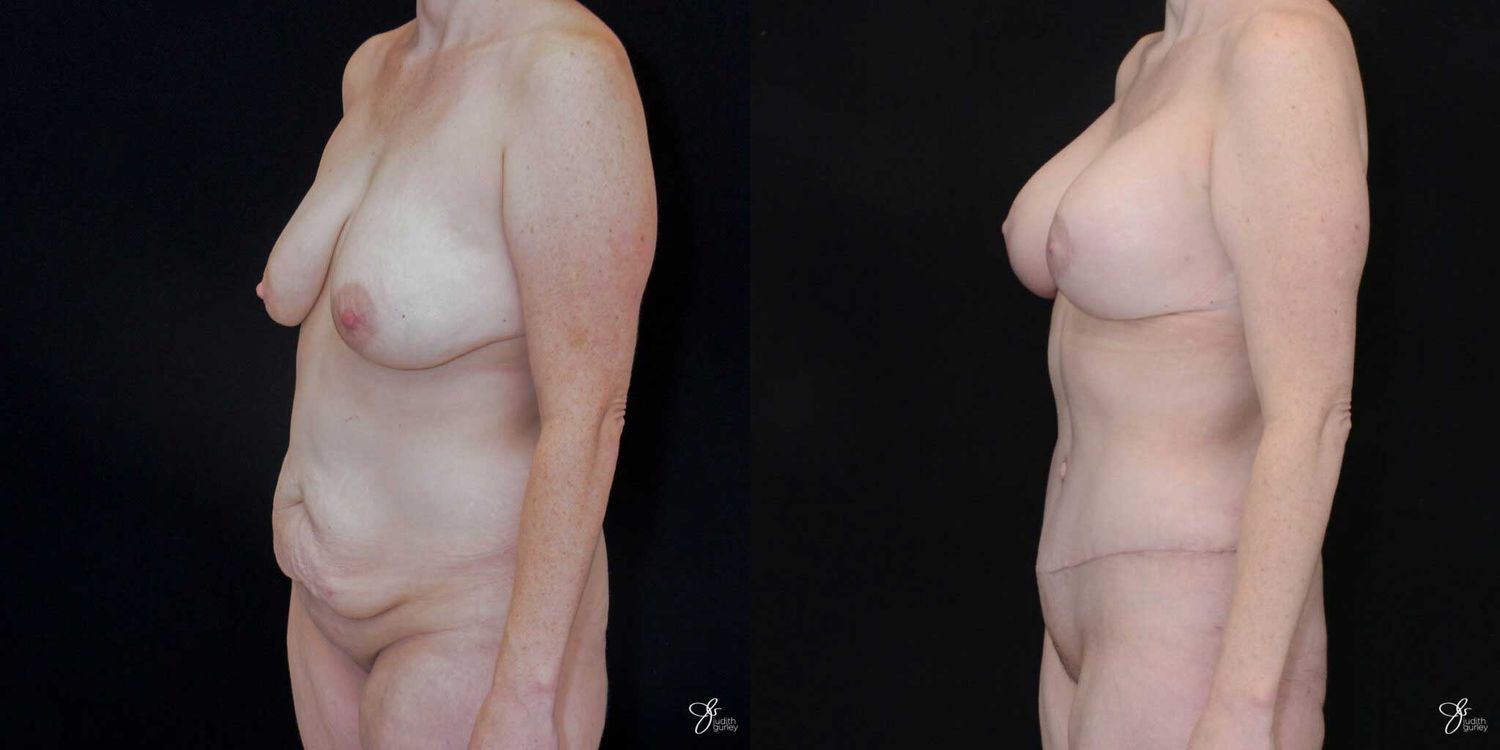 Mommy Makeover Before & After