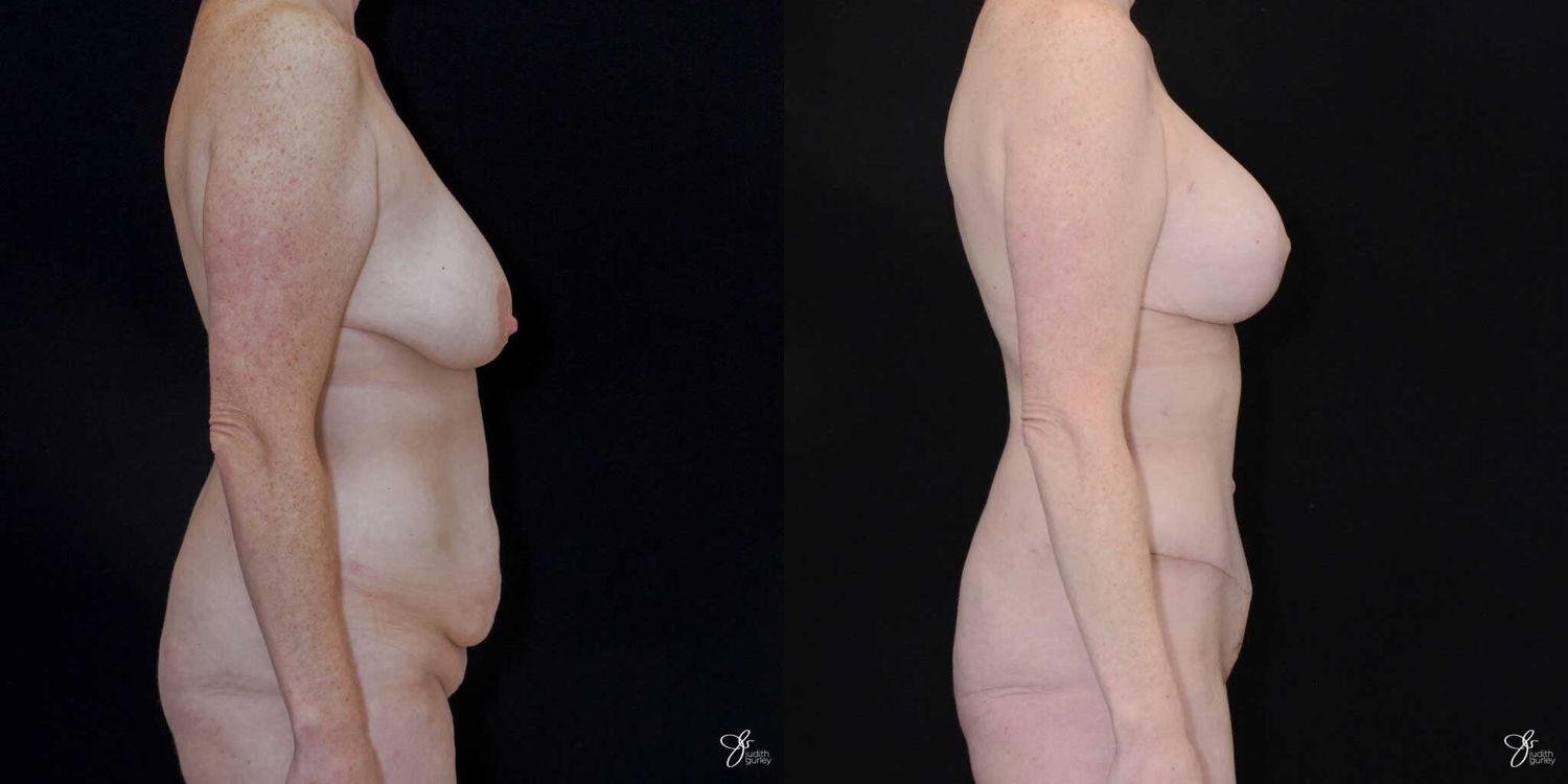 Mommy Makeover Before & After