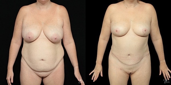 Mommy Makeover Before & After