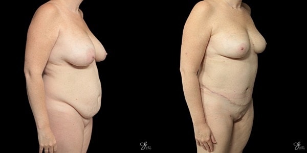 Mommy Makeover Before & After