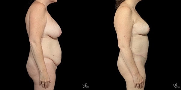 Mommy Makeover Before & After