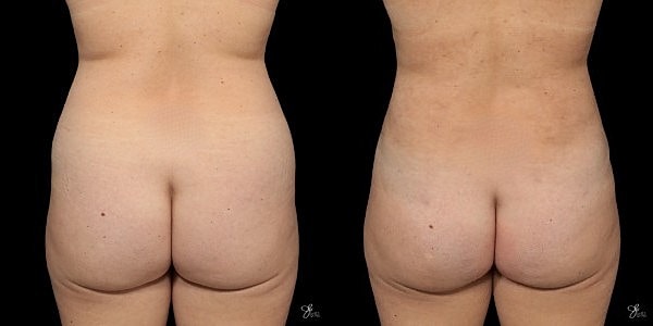Liposuction Before & After