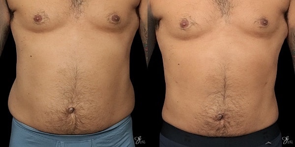 Liposuction Before & After