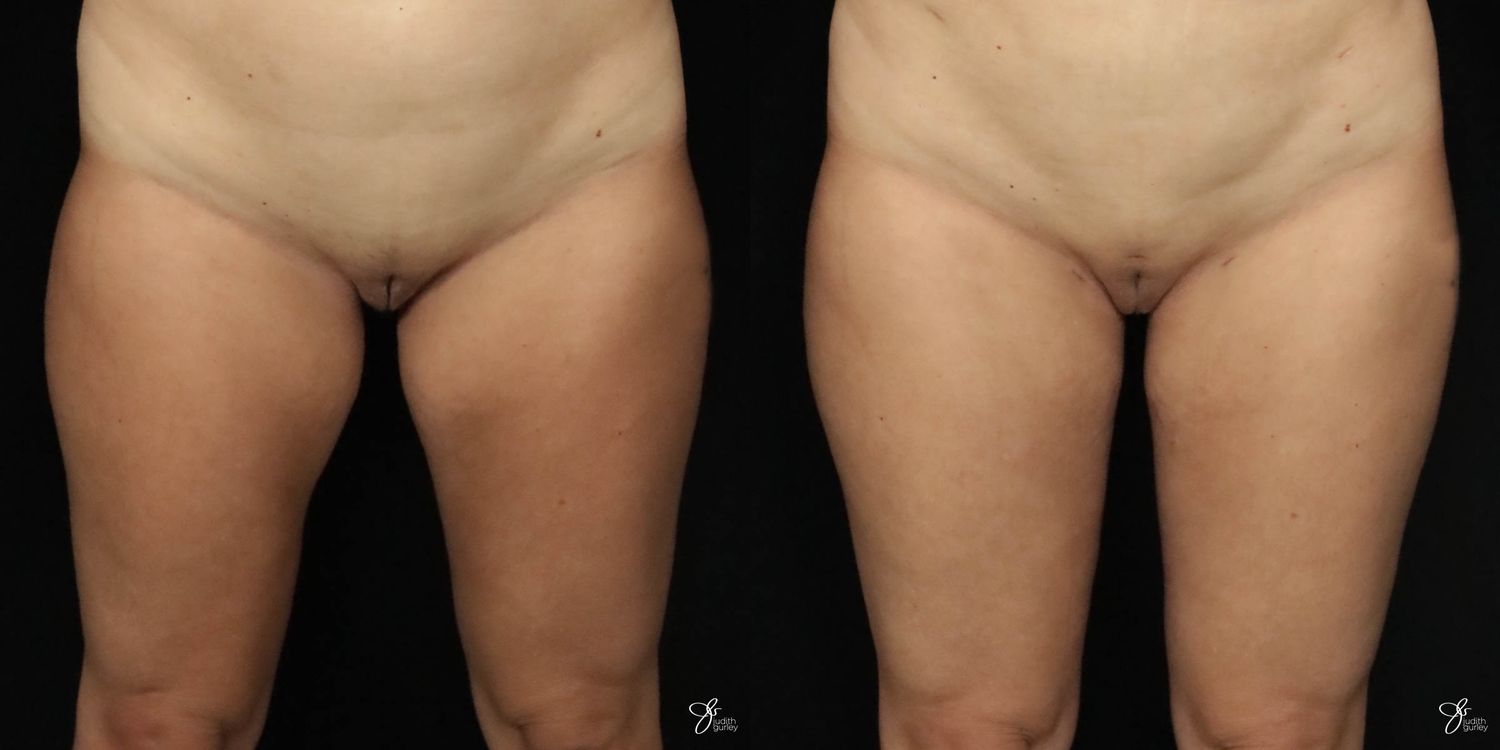 Liposuction Before & After