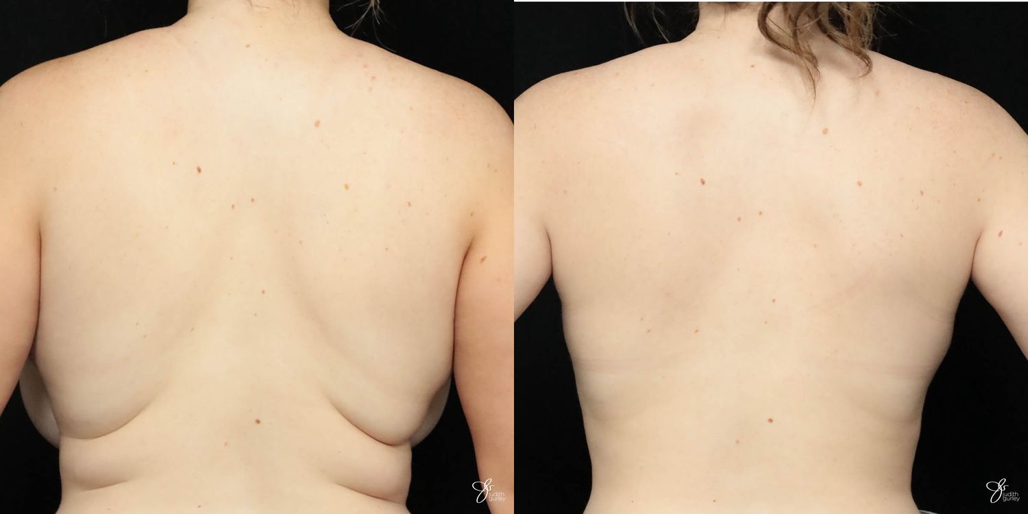 Liposuction Before & After