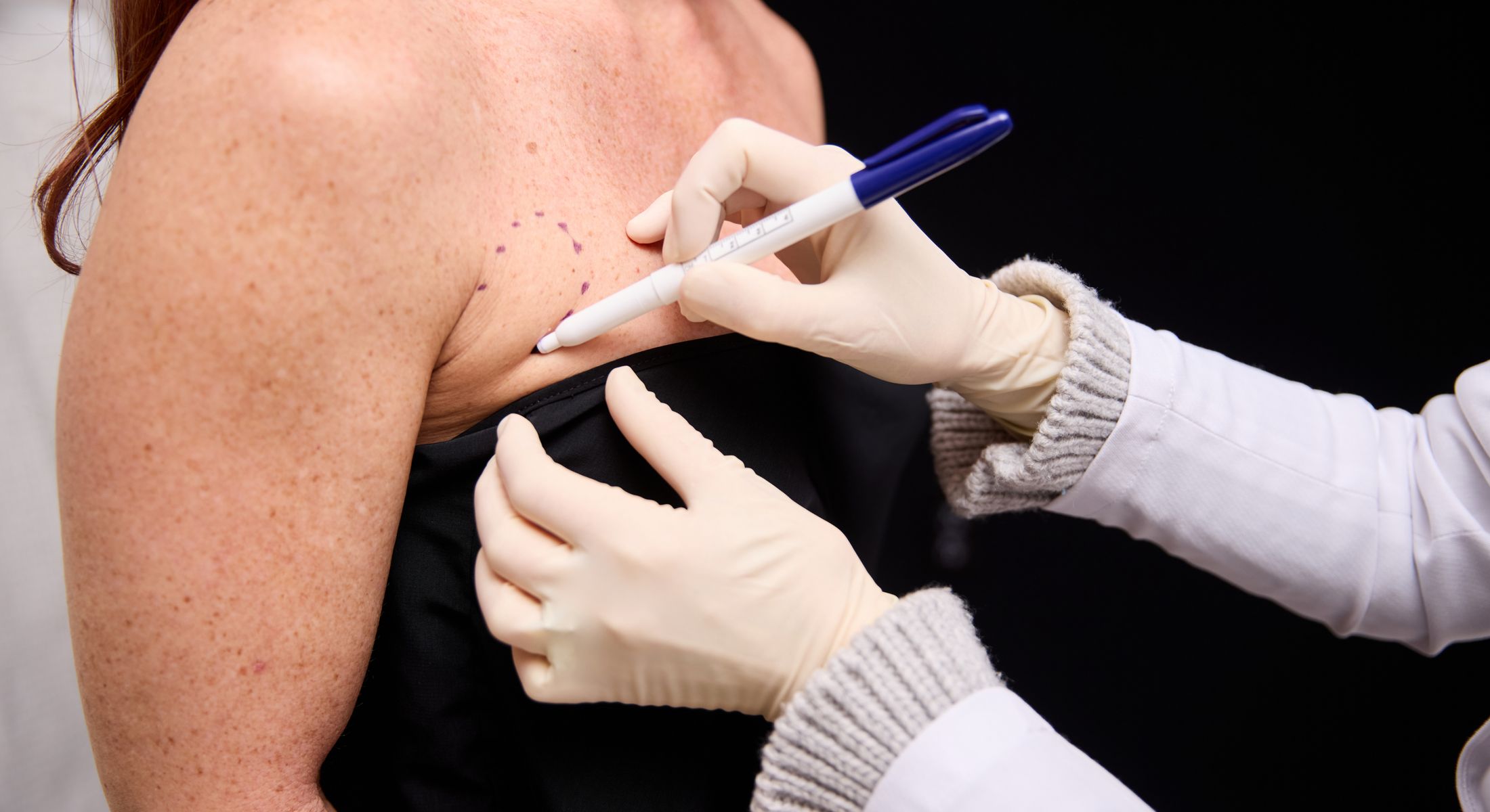 Doctor marking patient for cosmetic procedure consultation.